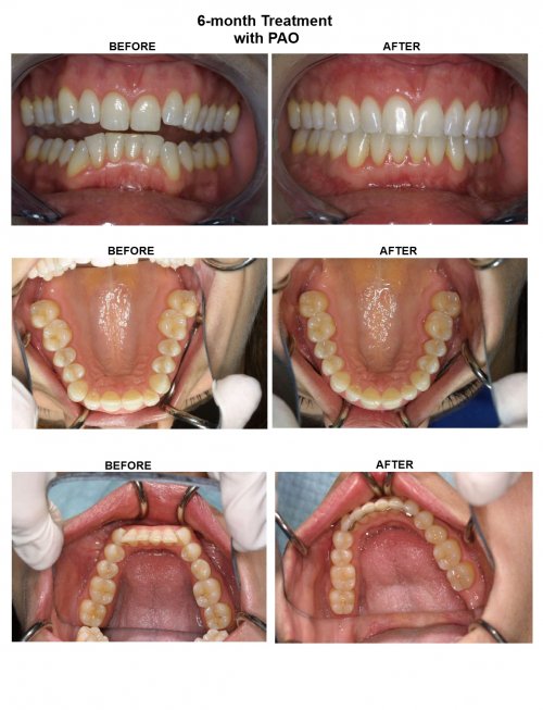 Cases treated in 6 months